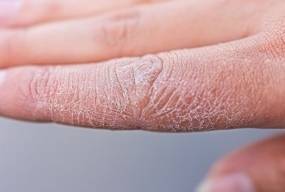 11 порад, як запобігти сухості шкіри взимку
