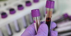 Чи впливає група крові на ризик діабету 2 типу: що показало дослідження