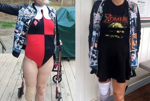 Девушке с диабетом отрезали ногу, пока она была в коме - изображение