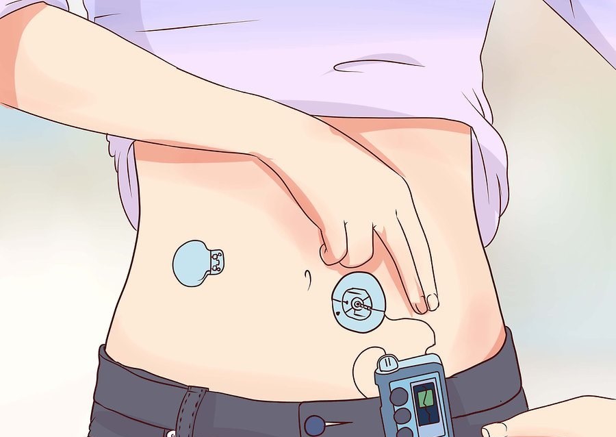 Выбираем место для инсулиновой помпы - рекомендации - 2 изображение