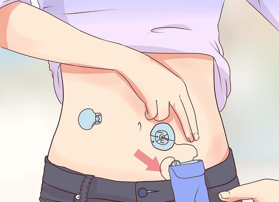 Выбираем место для инсулиновой помпы - рекомендации - 4 изображение