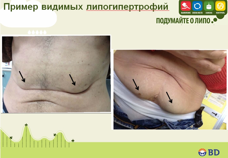 Липогипертрофия при диабете: инфографика, данные исследований. ПРЕЗЕНТАЦИЯ - 2 изображение