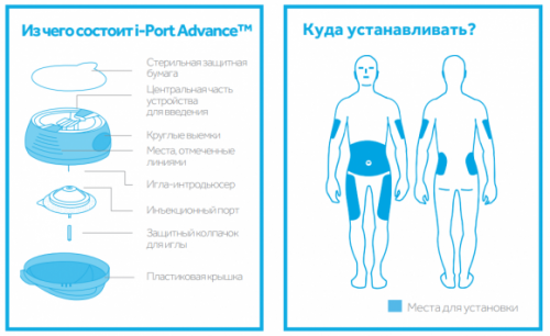 Инъекционный порт для безболезненного введения инсулина. Обзор от ``Сахарка`` - 3 фото Инъекционный порт для безболезненного введения инсулина. Обзор от ``Сахарка`` - 3 изображение