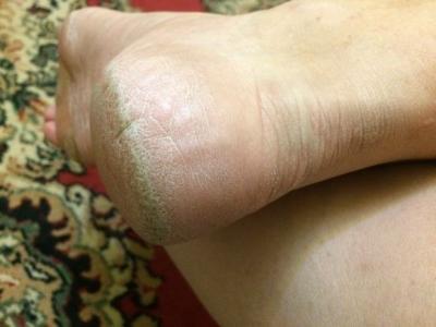 Применение крема Diabetegen при диабете: отчет 1 - 2 изображение