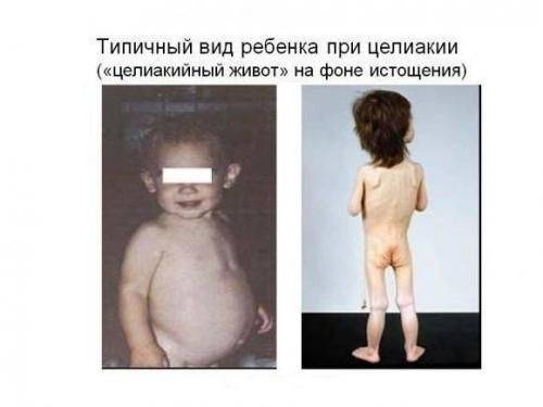 Аутоиммунные заболевания, ассоциированные с сахарным диабетом 1-го типа - 6 фото Аутоиммунные заболевания, ассоциированные с сахарным диабетом 1-го типа - 6 изображение