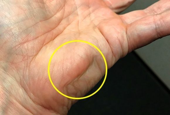 Причины мышечных судорог и спазмов при диабете - 6 фото Причины мышечных судорог и спазмов при диабете - 6 изображение