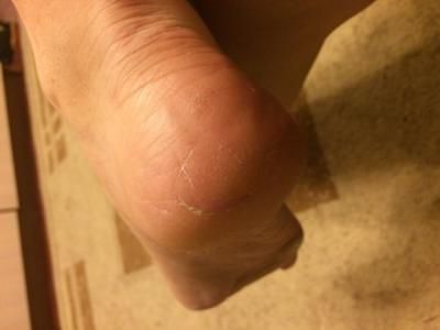 Применение крема Diabetegen при диабете: отчет 1 - 3 изображение