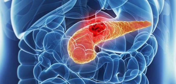 Инсулинома - редкая опухоль, секретирующая инсулин. Диагностирование и способы лечения - 2 фото Инсулинома - редкая опухоль, секретирующая инсулин. Диагностирование и способы лечения - 2 изображение