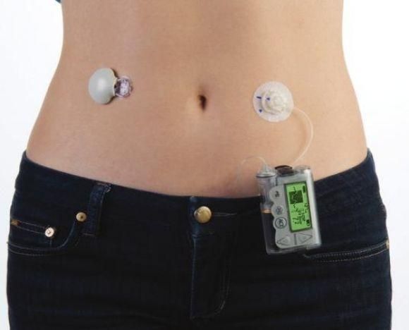 Исследование эффективности систем постоянного мониторинга глюкозы в предотвращении гипогликемий - 2 фото Исследование эффективности систем постоянного мониторинга глюкозы в предотвращении гипогликемий - 2 изображение