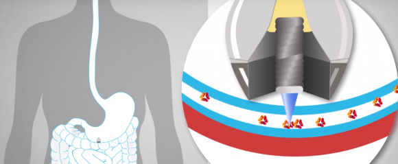 SOMA. Инсулин в таблетках!!! - 3 изображение