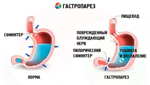 Гастропарез при диабете: причины, симптомы, лечение - рекомендации ADA - 3 изображение