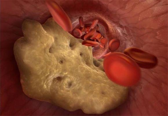 Как быстро почистить сосуды? Советы доктора - 2 фото Как быстро почистить сосуды? Советы доктора - 2 изображение