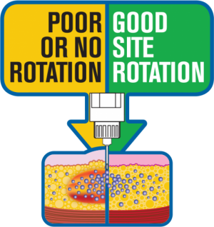 SiteSmart: простой способ чередования мест инъекций инсулина. Обзор новинки - 2 изображение