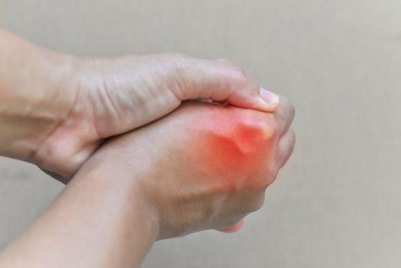 Подагра. Болезнь изобилия как риск заболеваний сердца и диабета - 3 фото Подагра. Болезнь изобилия как риск заболеваний сердца и диабета - 3 изображение