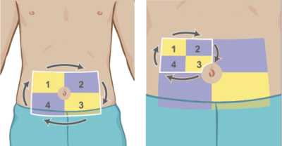 ТОП-5 cоветов для безболезненных инъекций инсулина от SaharOK Journal - 3 фото ТОП-5 cоветов для безболезненных инъекций инсулина от SaharOK Journal - 3 изображение