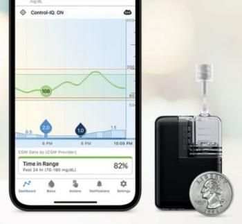 Tandem Mobi: найменша у світі штучна підшлункова виходить на діабет-ринок. Що нам відомо про новинку - 2 фото Tandem Mobi: найменша у світі штучна підшлункова виходить на діабет-ринок. Що нам відомо про новинку - 2 изображение