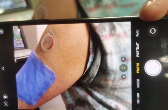 3D пластир розпізнає ризик діабету, серцевих захворювань та ниркової недостатності за допомогою поту - 2 фото 3D пластир розпізнає ризик діабету, серцевих захворювань та ниркової недостатності за допомогою поту - 2 изображение