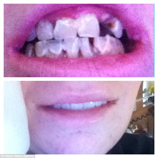 Отказалась от инсулина: потеряла зубы и волосы! - 4 изображение