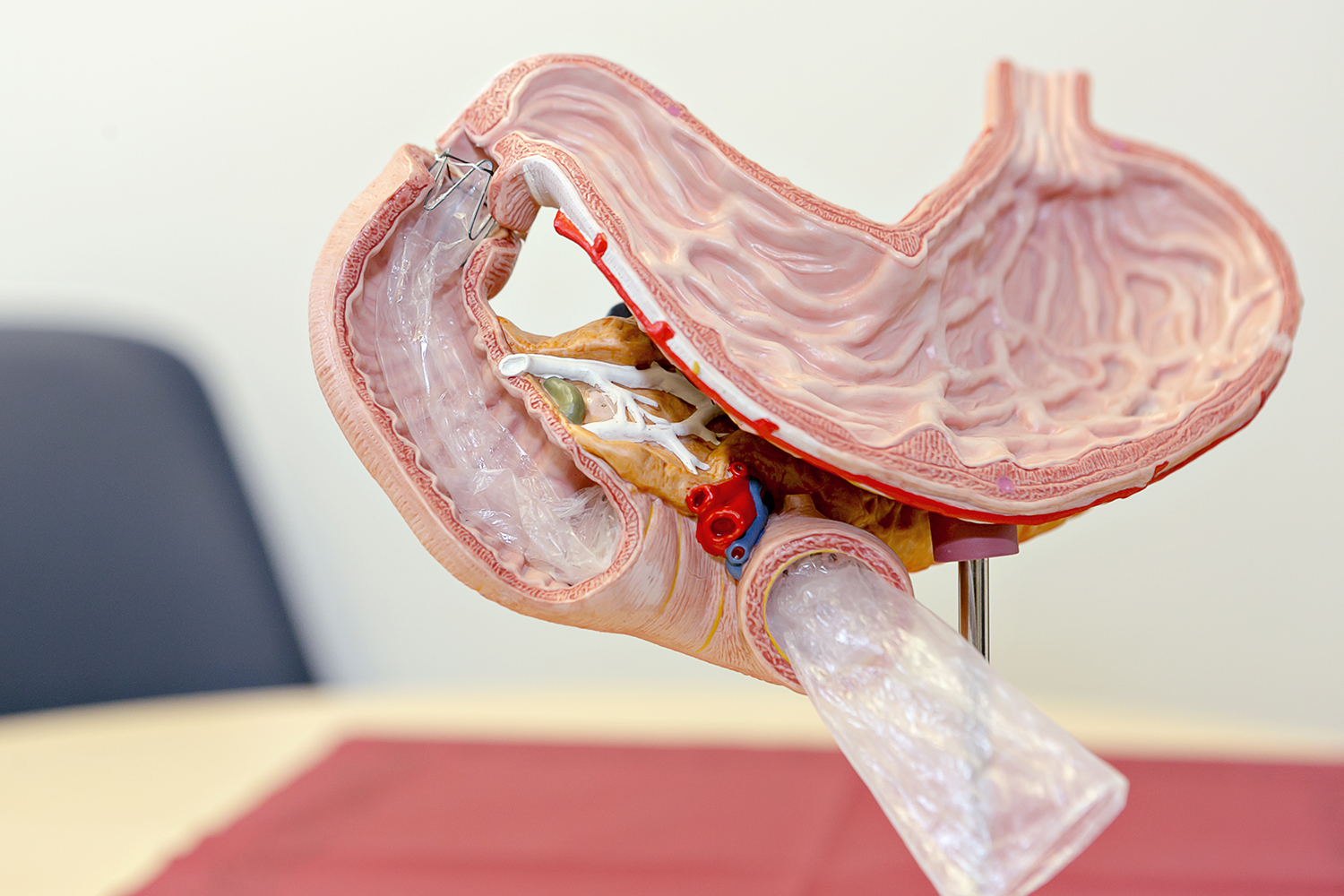 EndoBarrier - новая технология снижения веса при диабете - 2 изображение