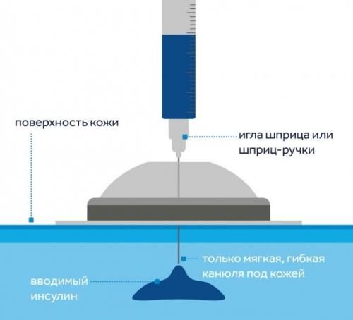 Инъекционный порт для безболезненного введения инсулина. Обзор от ``Сахарка`` - 2 изображение