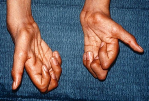 Причины мышечных судорог и спазмов при диабете - 5 изображение