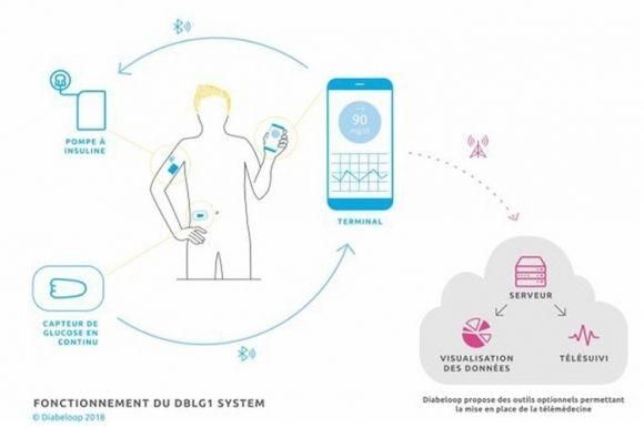 В Европе одобрена новая искусственная поджелудочная железа - 2 изображение