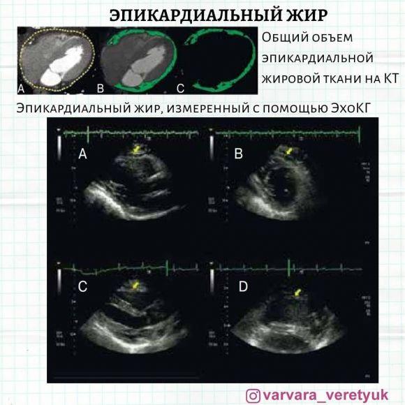 Жир вокруг сердца - 4 изображение
