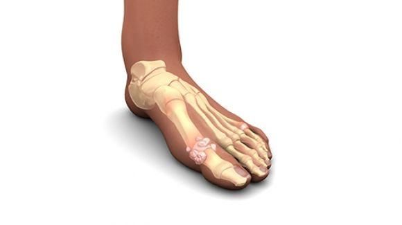 Подагра. Болезнь изобилия как риск заболеваний сердца и диабета - 2 изображение