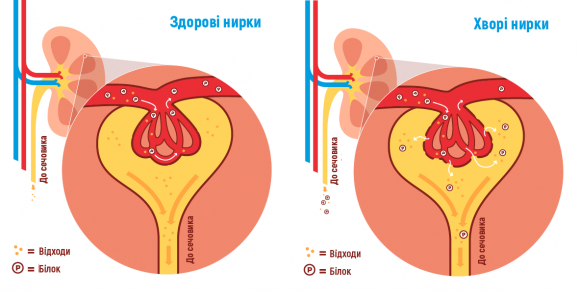 Ускладнення діабету: діабетична нефропатія - 2 изображение